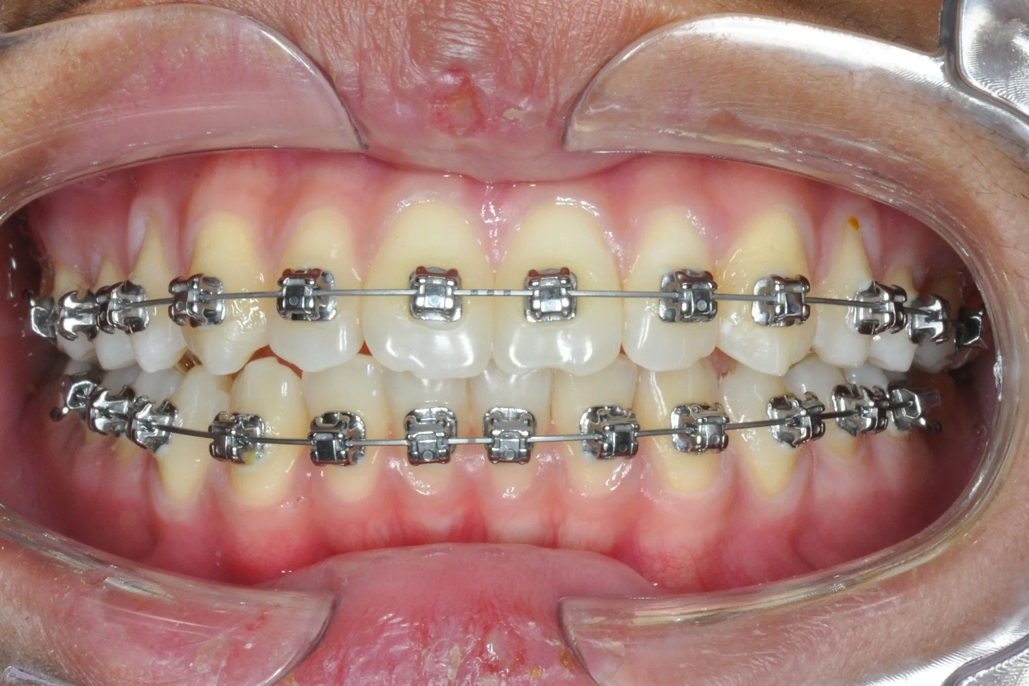 Behel Konvensional vs Self Ligating