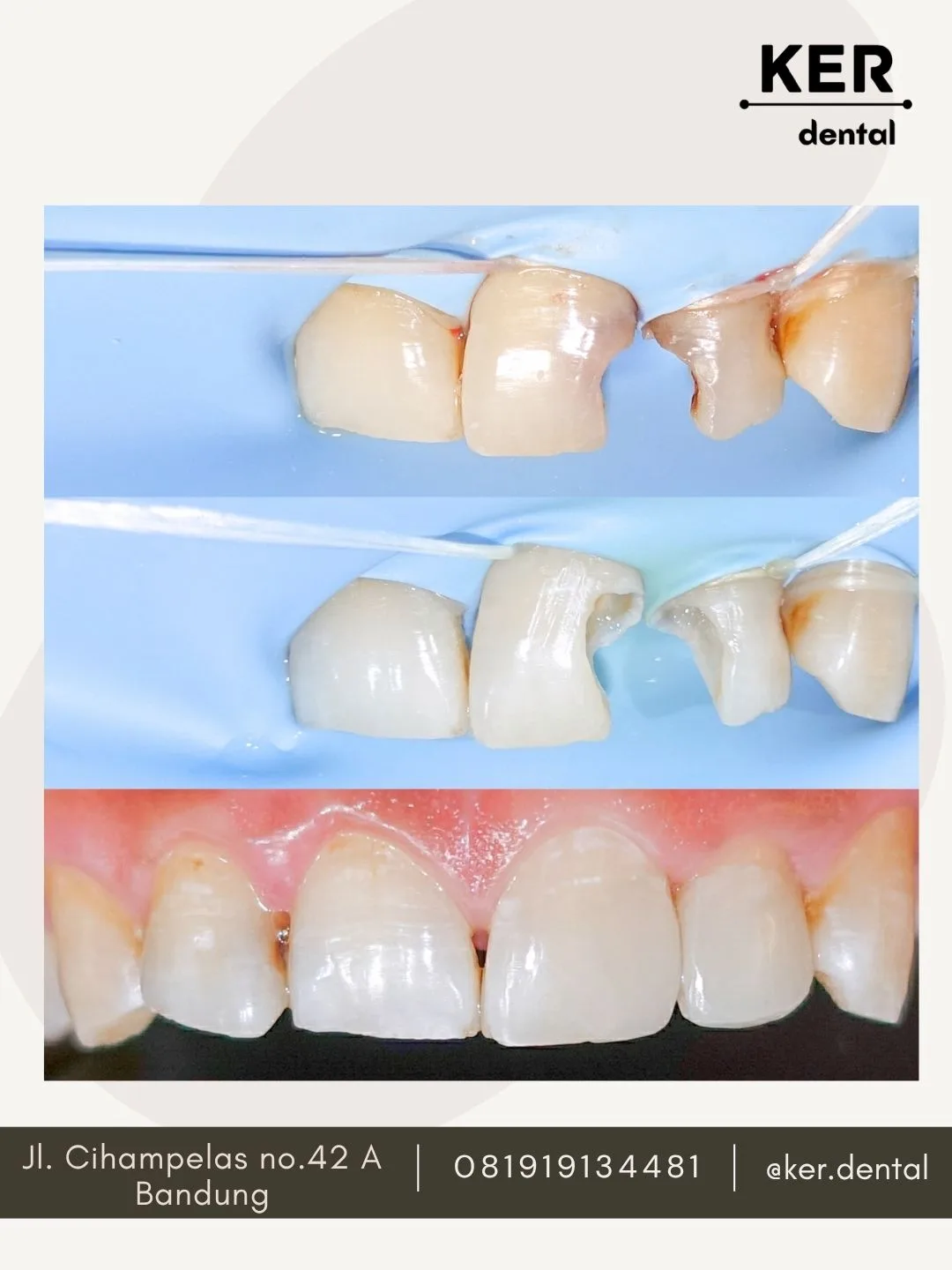 Veneer Gigi