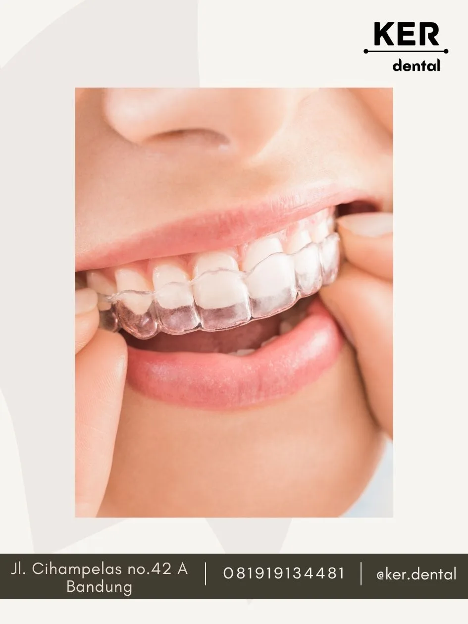 Clear Aligner