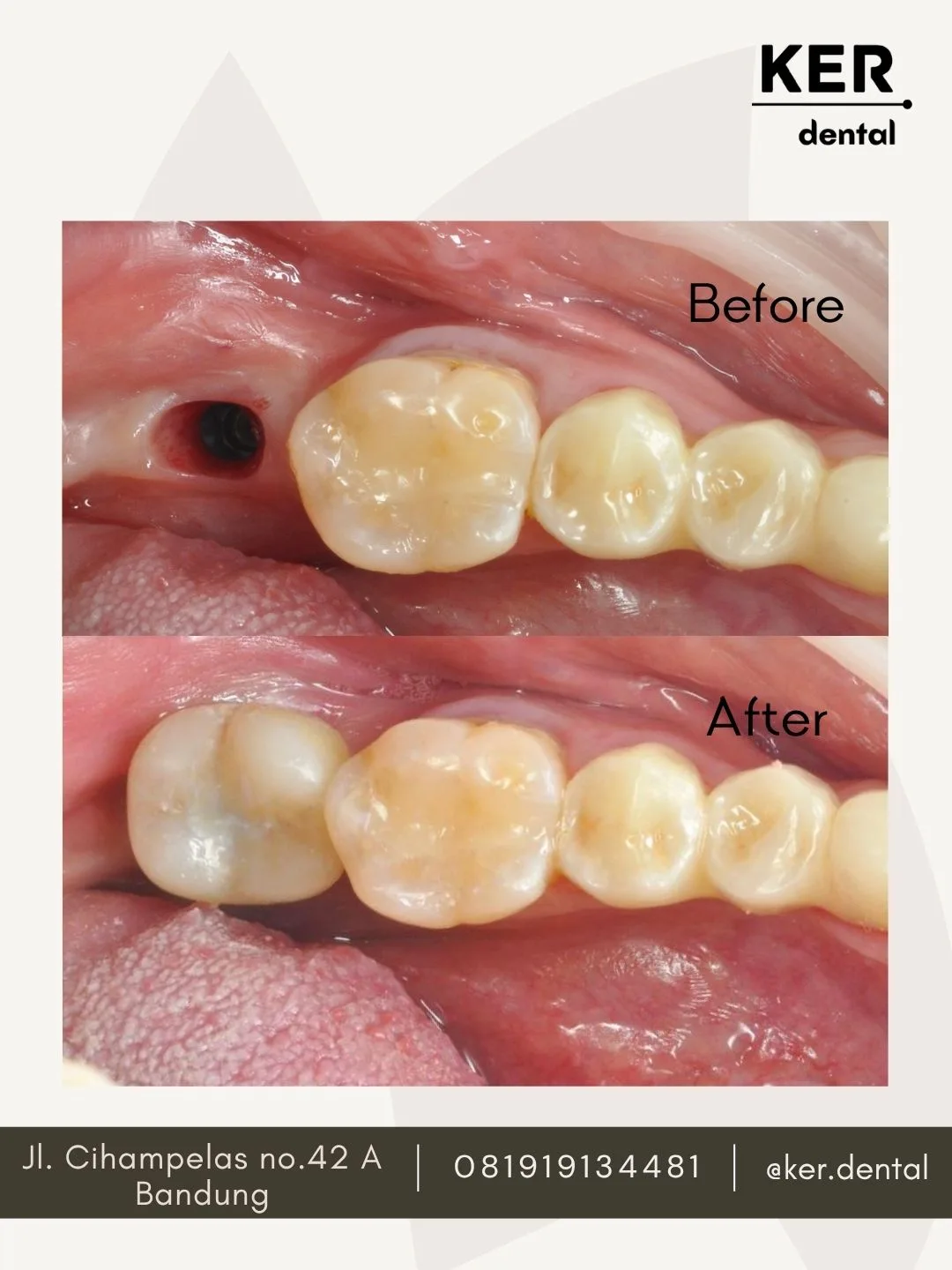 Implant Gigi