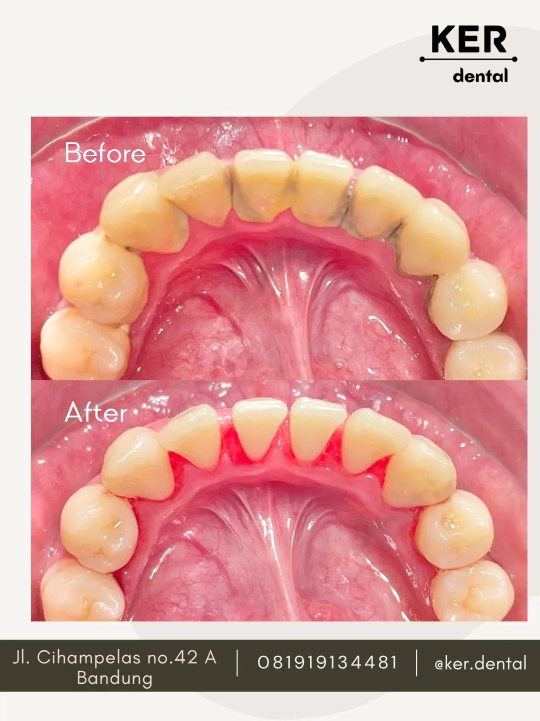 Scaling & Polishing