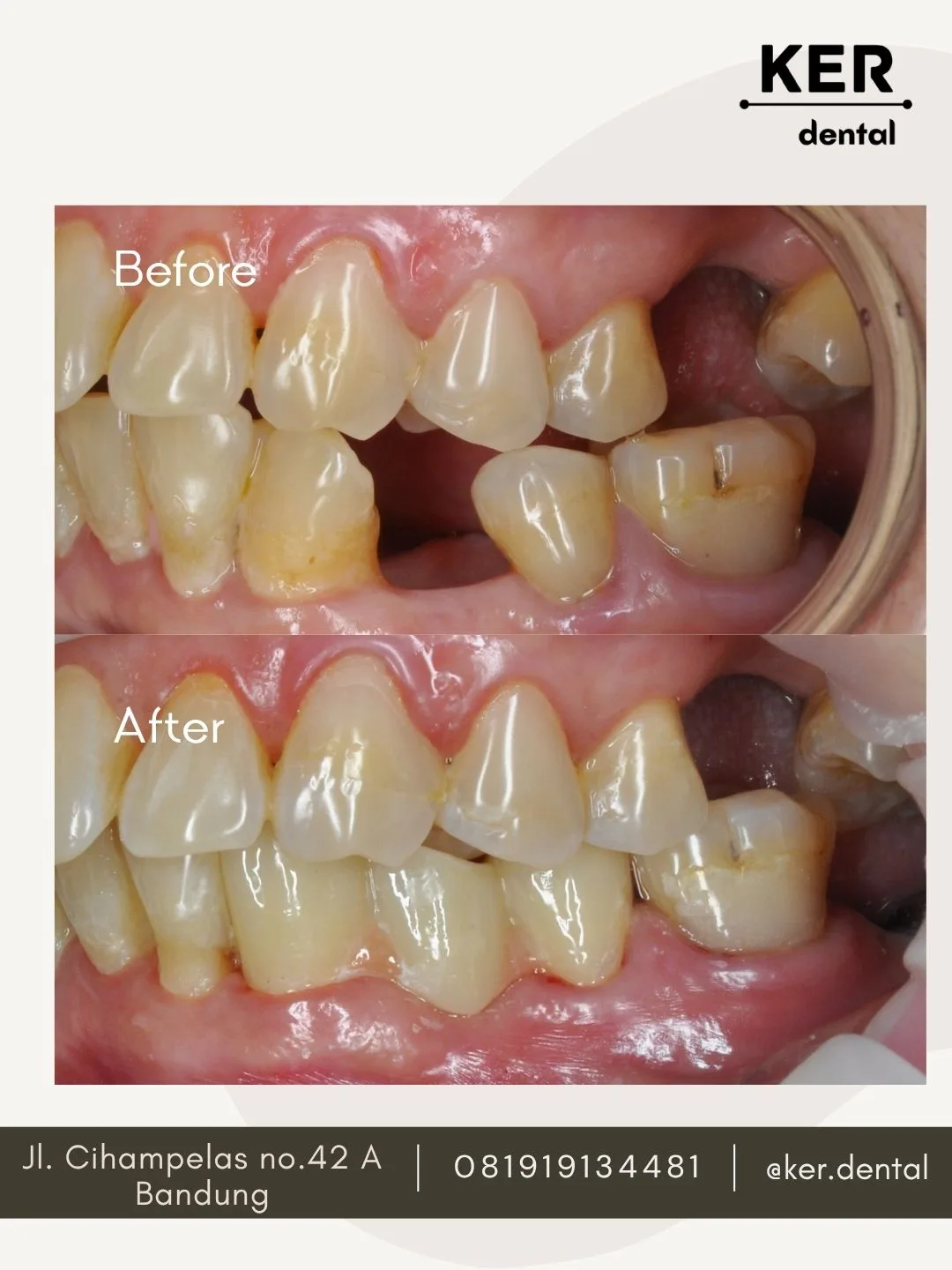 Dental Bridge