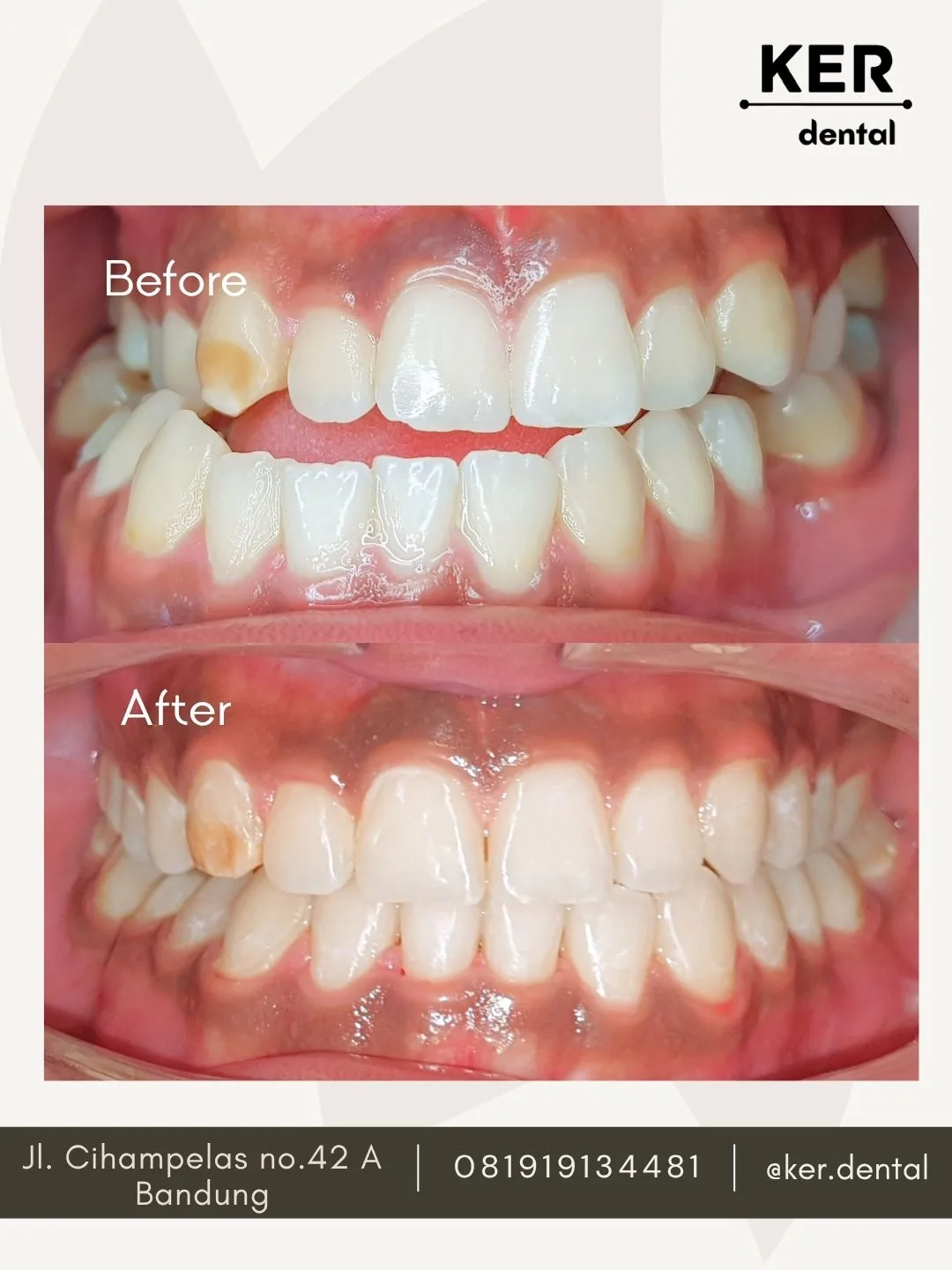 Perawatan Ortodonti dengan Bedah Rahang (Orthognathic Surgery)